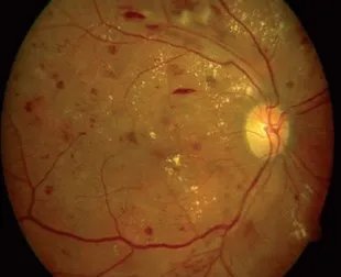 Vinay A. Shah, MD | Diabetic Eye Disease
