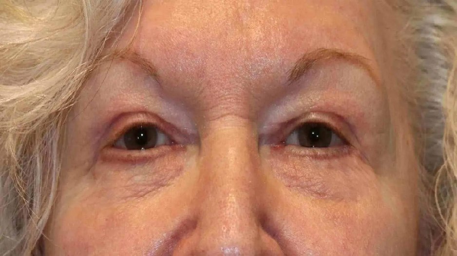 Woman after bilateral eyelid blepharoplasty in Oklahoma City